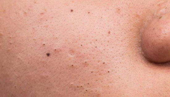 روش های از بین بردن جوش های سر سیاه