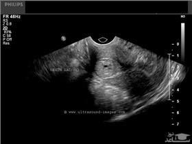 مشکلات بارداری و زایمان در خانم های سن بالا