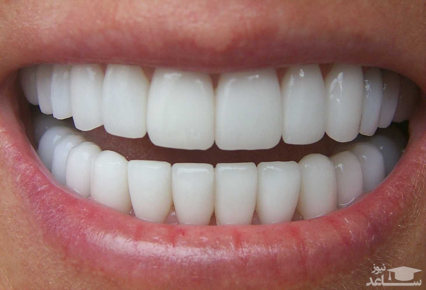 ایمپلنت دندان های جلو و نکات مهم در مورد آن
