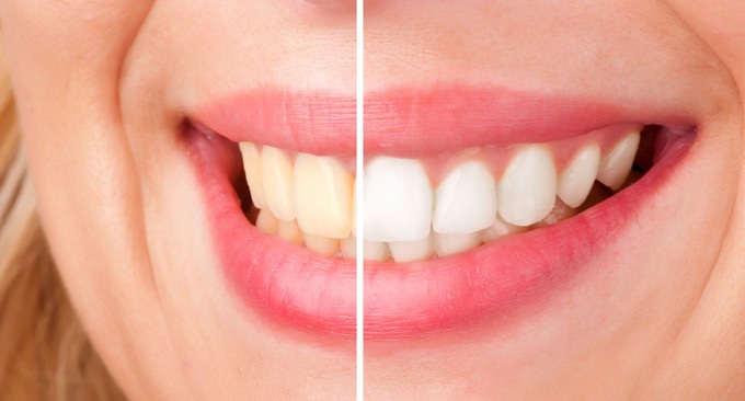 چه خوردنی هایی باعث زرد رنگ شدن دندان های می شوند؟