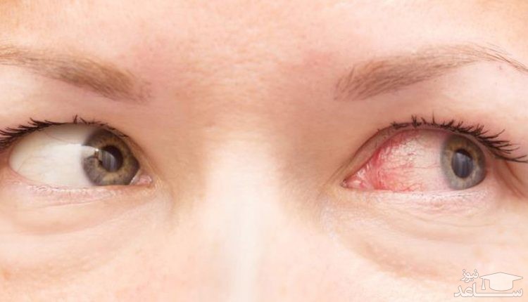 آشنایی با بیماری عفونت چشم