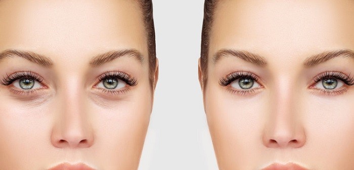 آنچه که باید در مورد جراحی پلک بدانیم