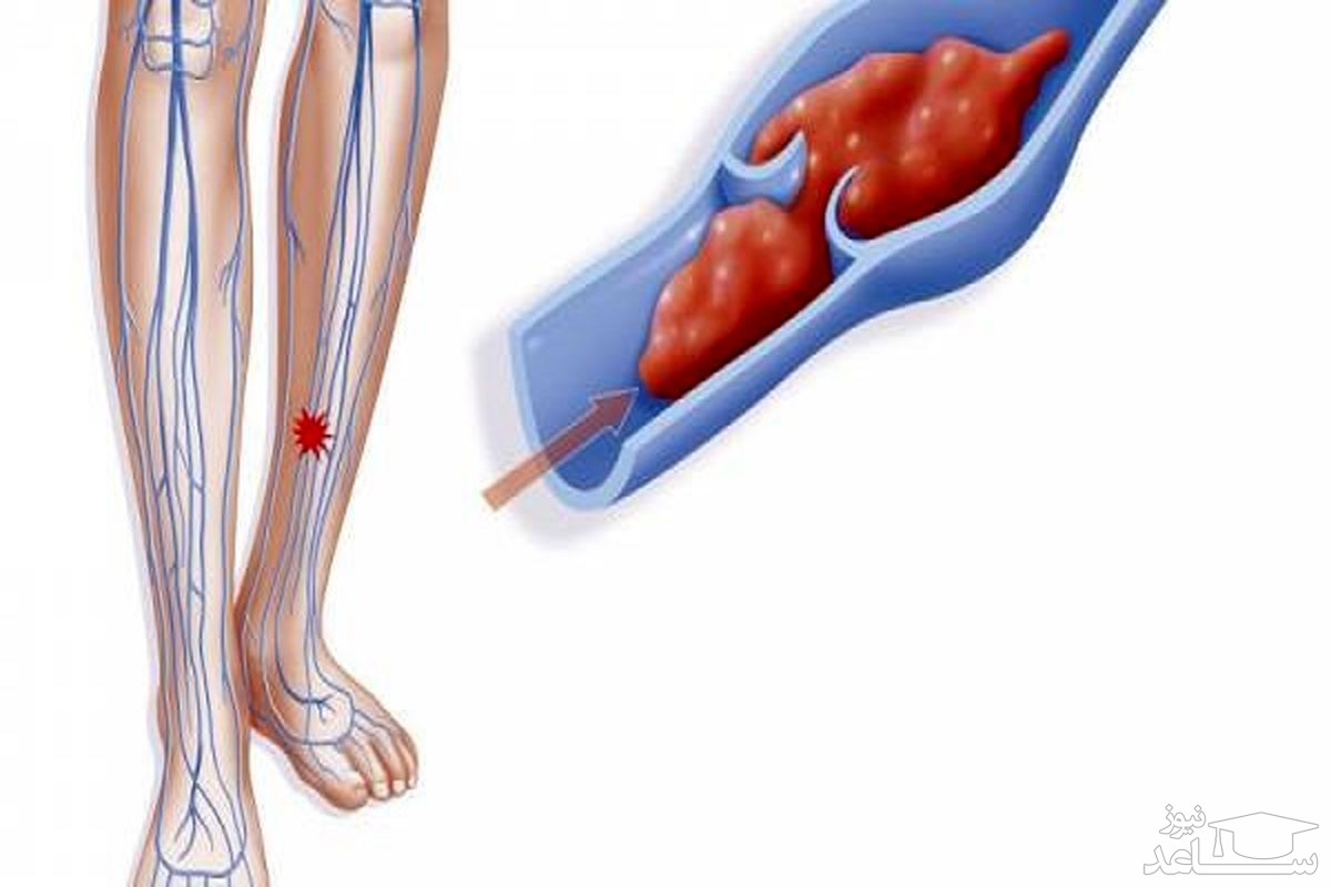 لخته شدن خون در پا (DVT) یا ترومبوز