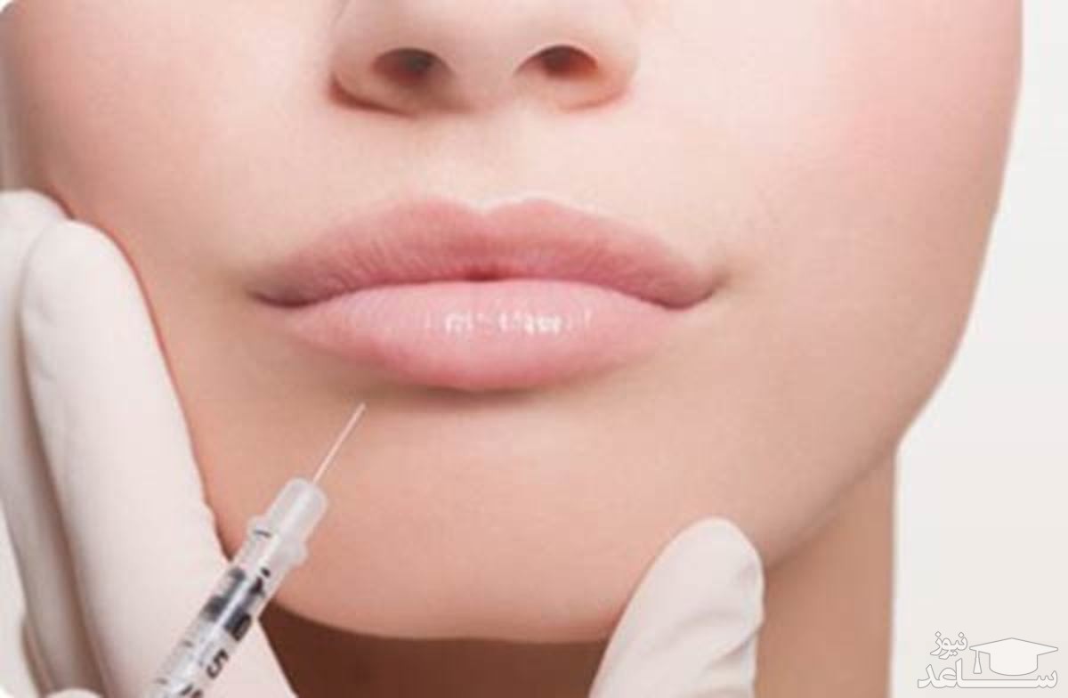 نکات طلایی مراقبتی بعد از تزریق ژل لب