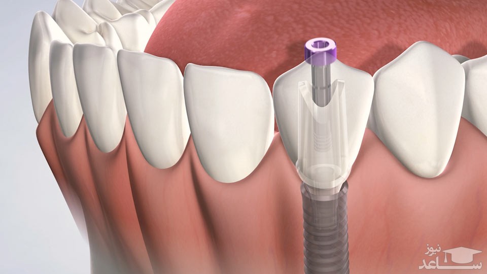 چه مدت پس از کشیدن دندان ایمپلنت انجام دهیم؟