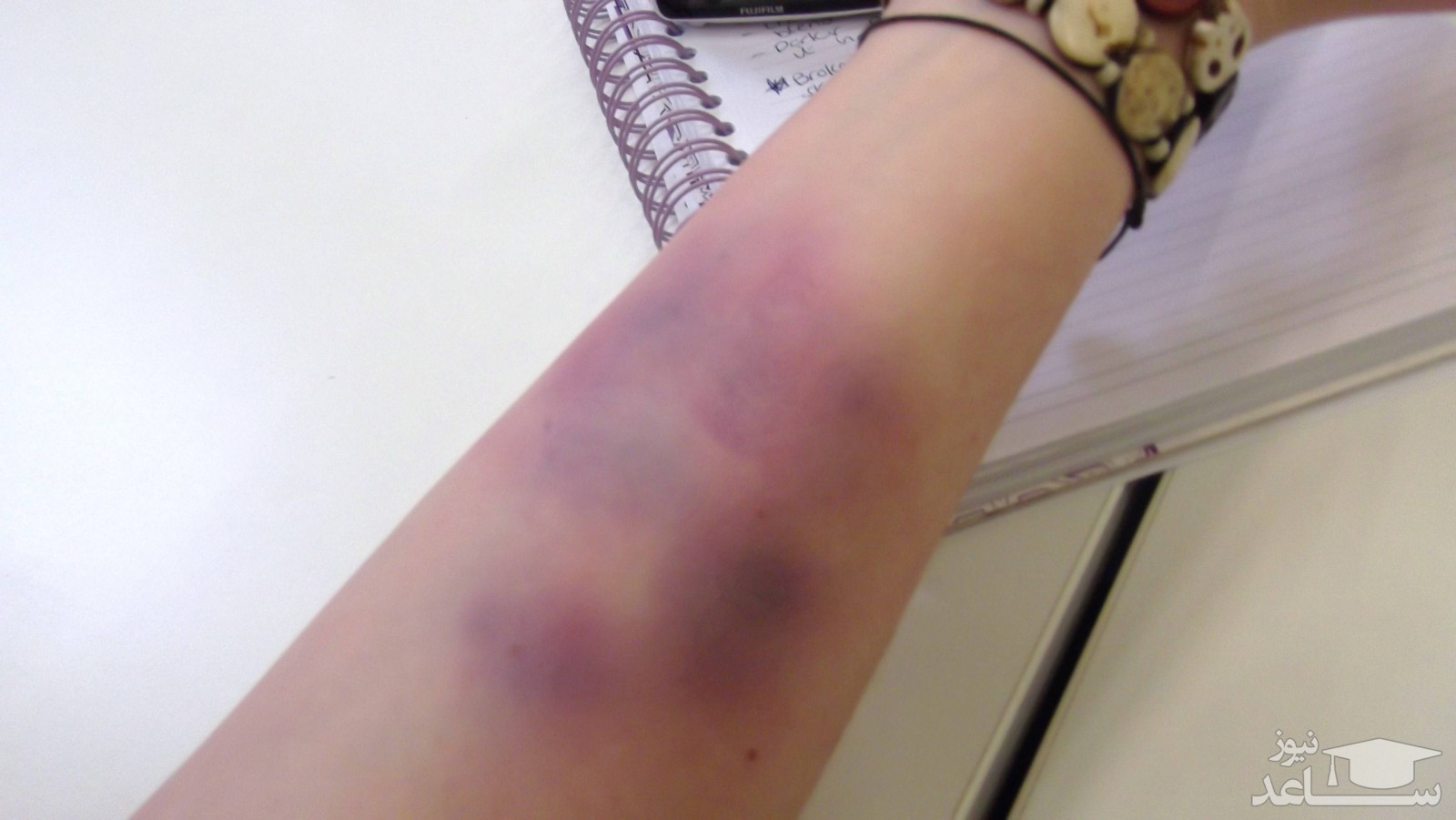 علل کبود شدن سریع پوست و راههای درمان آن