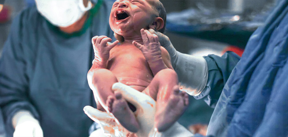 تاثیر زایمان بر فیبروم های رحمی