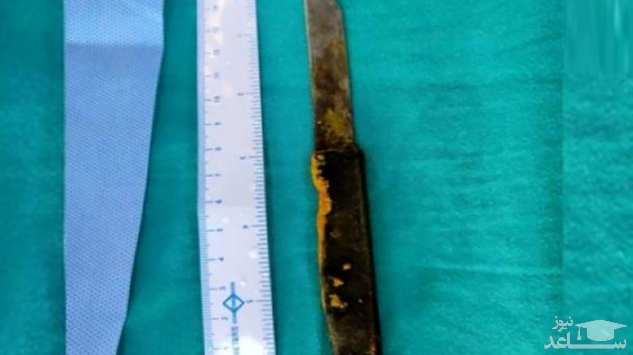 خروج چاقوی ۲۰ سانتی از کبد مرد هندی جراحان را شگفت‌ زده کرد