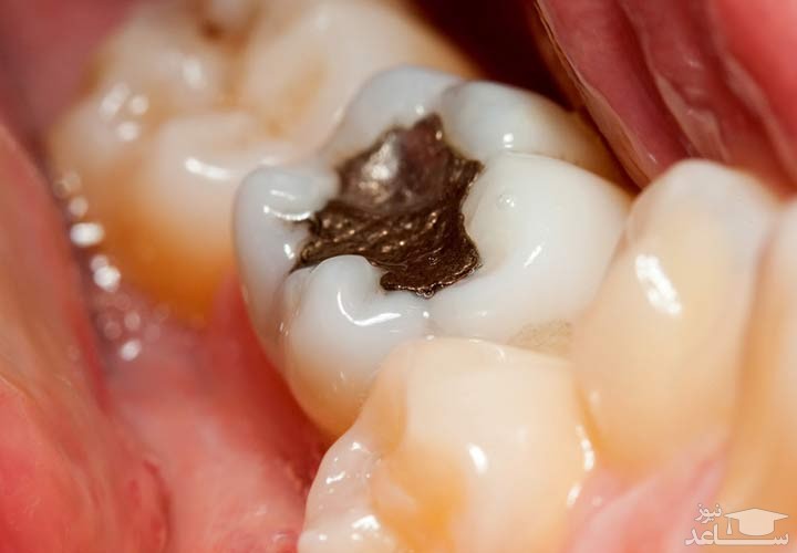 باکتری " استرپتوکوکوس موتانس "عامل اصلی پوسیدگی دندان