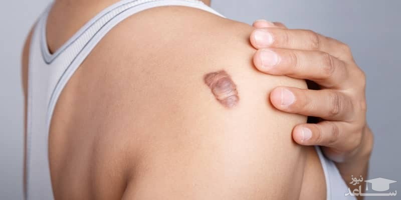 هر آنچه باید در مورد کلوئید پوستی بدانید