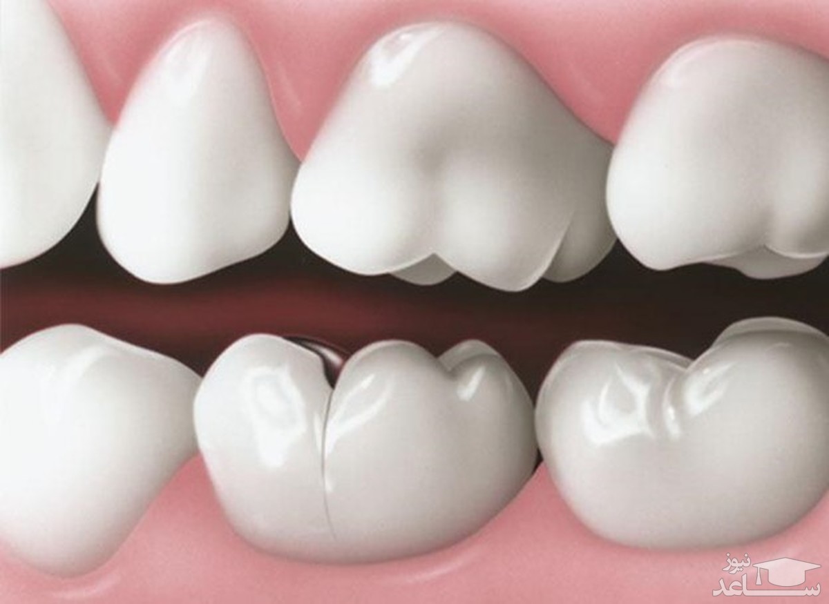 شقاق دندانی چیست؟