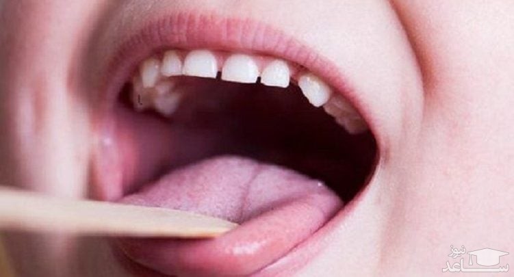 علت التهاب یا گلوسیت زبان چیست؟