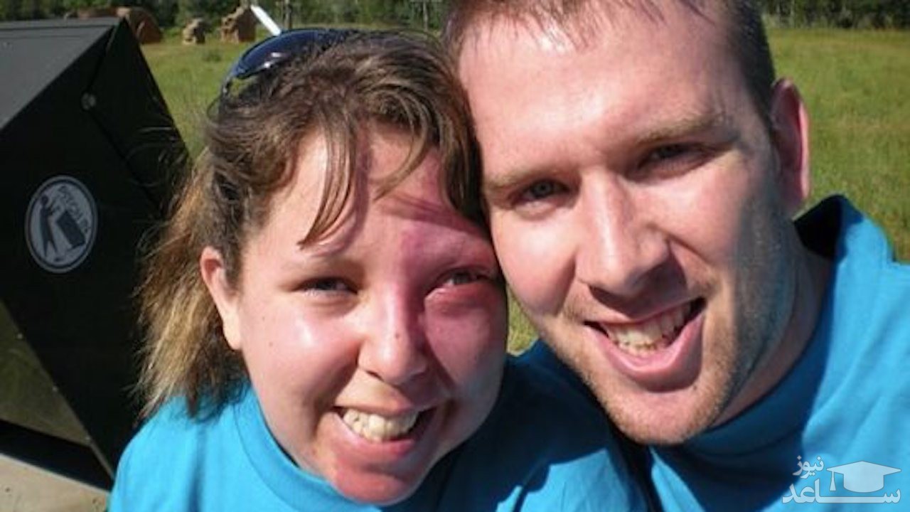 ماجرای ازدواج زنی که به دلیل ماه گرفتگی هیولا خطابش می‌ کردند