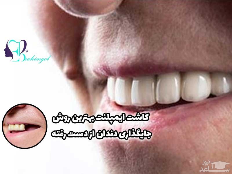 کاشت ایمپلنت فوری در کوتاه ترین زمان ممکن