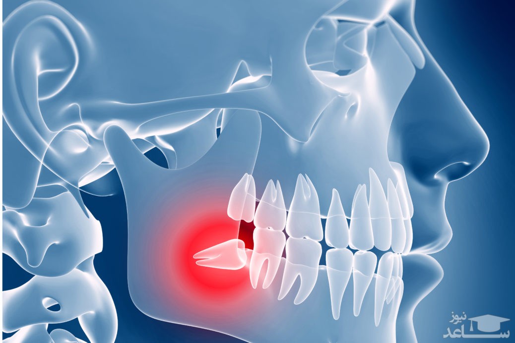 مراقبت های بعد از کشیدن و جراحی دندان عقل