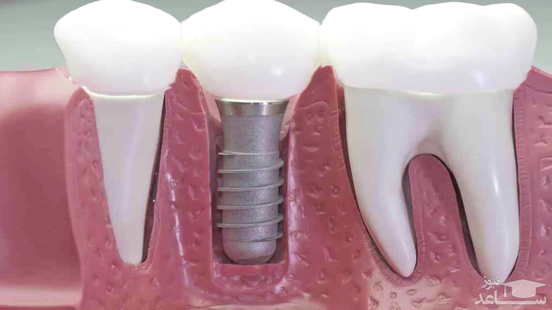 بعد از ایمپلنت دندان کی باید به دکتر مراجعه کرد؟