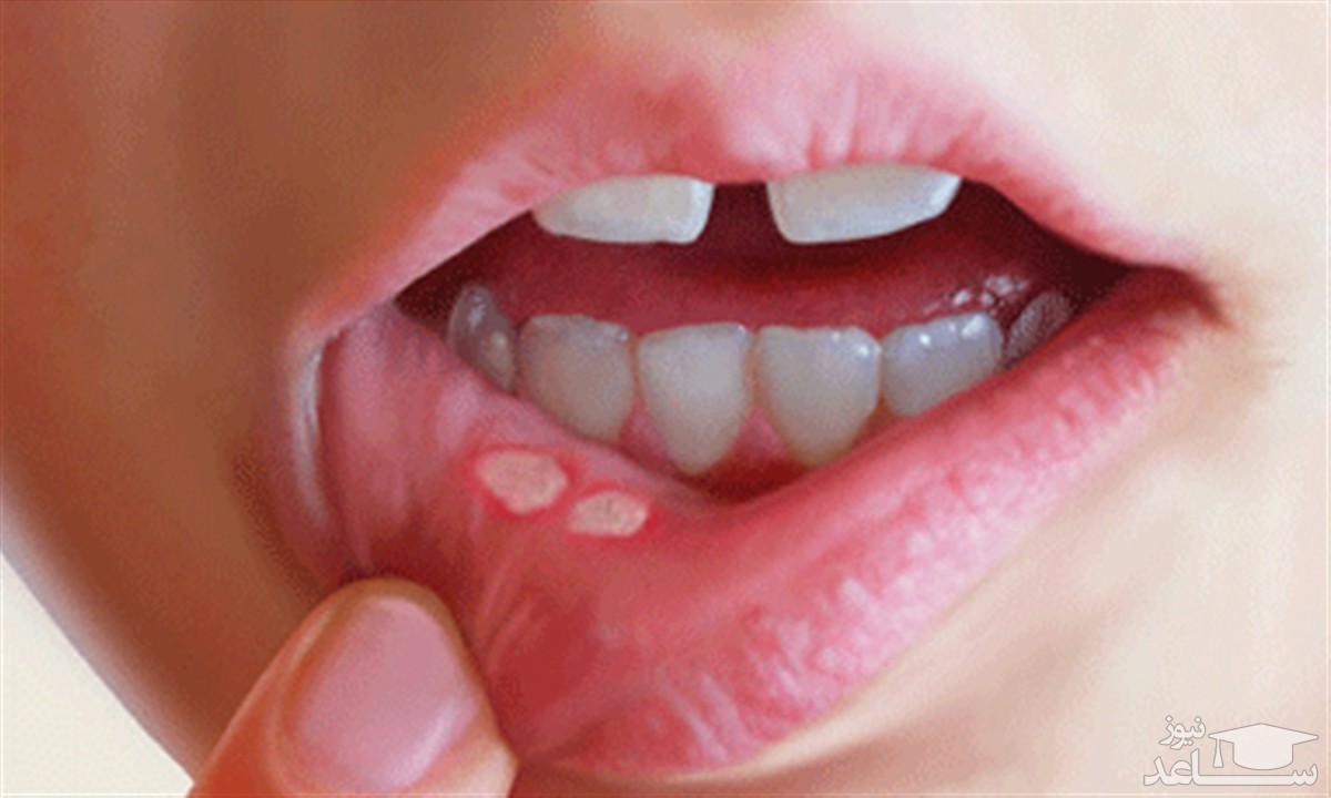 بهبود آفت دهان با تغذیه مناسب
