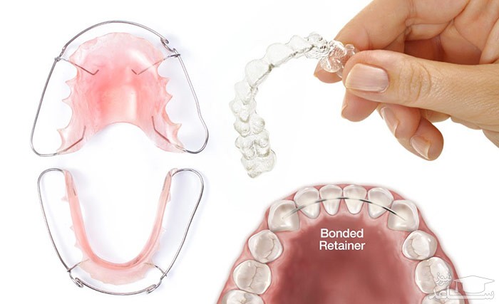 ارتودنسی ثابت و متحرک، کدامیک بهتر است؟