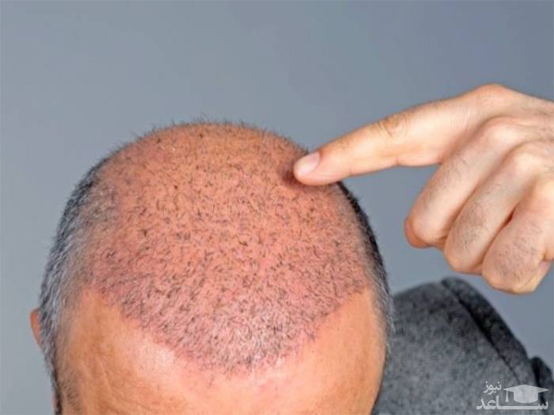 پوستر کاشت مو