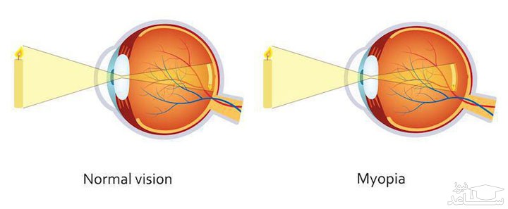 نزدیک بینی چشم چیست؟