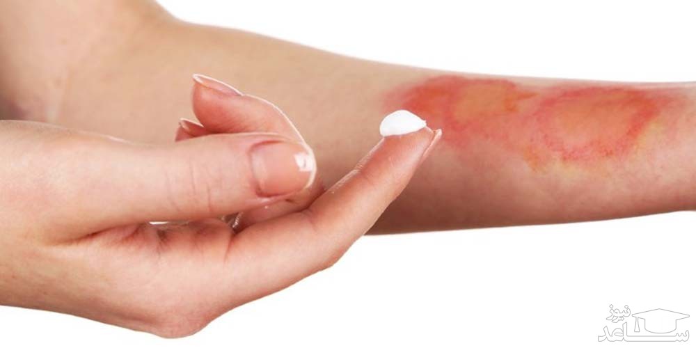 سیلور سولفادیازین-موضعی