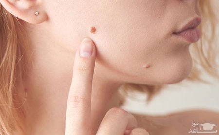 خال گوشتی و راه های از بین بردن آن