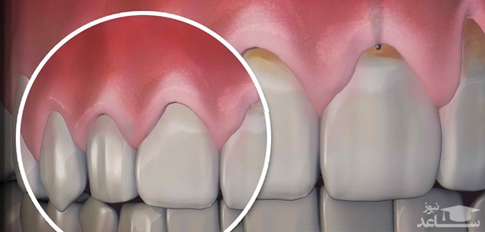 علت ها و دلایل تحلیل لثه