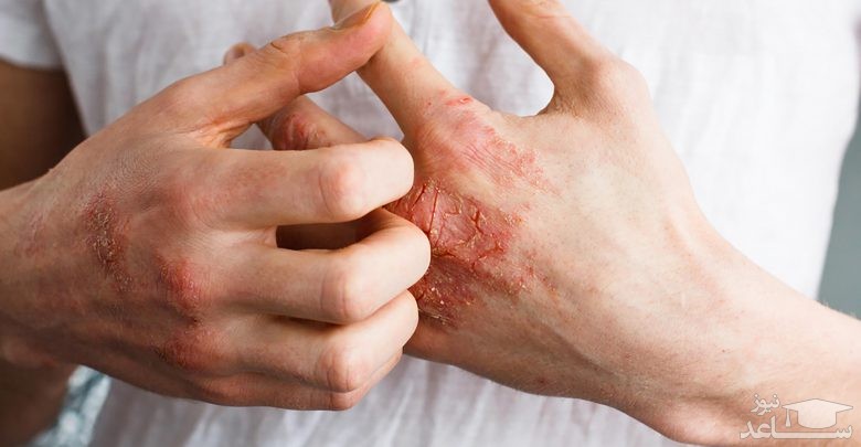 انواع سوختگی و درجات مختلف آن