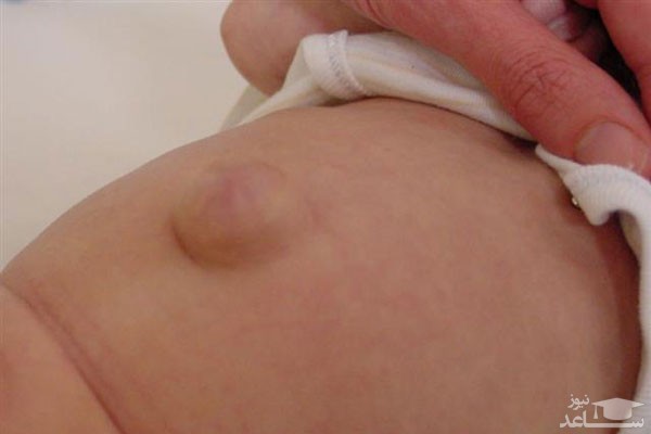 علایم و نشانه های فتق ناف در نوزاد