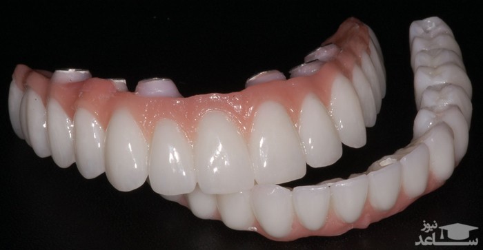 تفاوت ها و شباهت های ایمپلنت دندان ثابت، اوردنچر و دندان مصنوعی متحرک