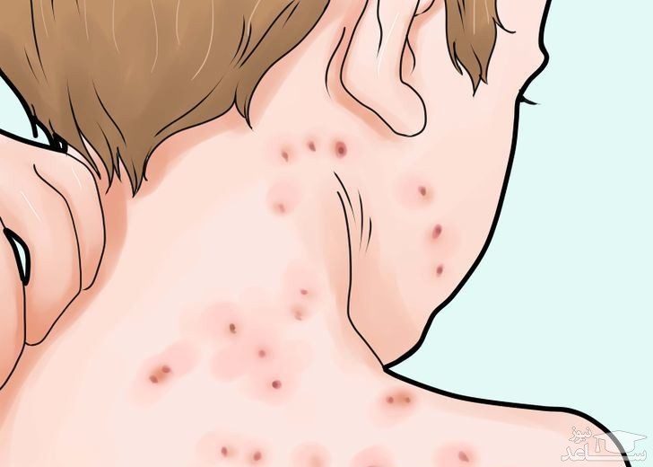 میزان، تاثیرات و مکانیزم اثر واکسن واریسلا-زوستر