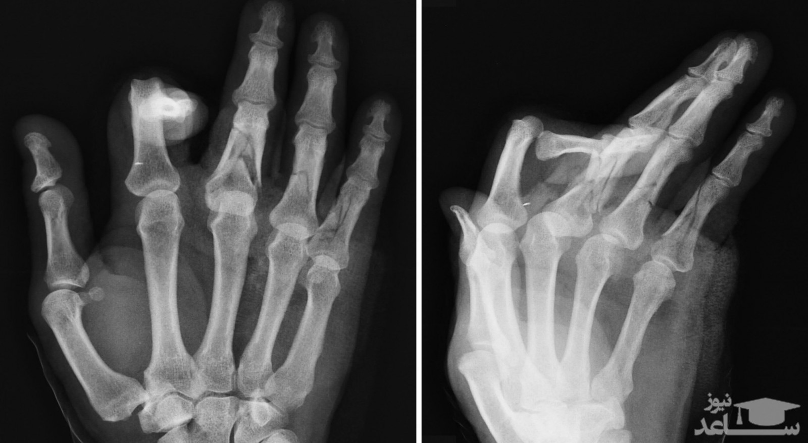 عکس رادیولوژی شکستگی انگشت دست