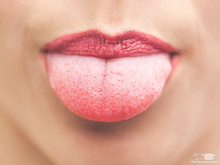 جوش روی زبان می تواند نشان دهنده ی سرطان باشد؟