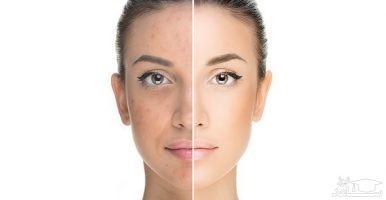 7 عادتی که منجبر به باقی ماندن جای جوش میشود