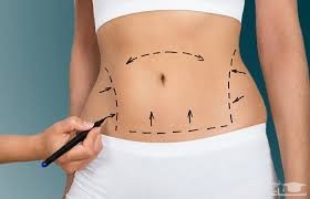 ابدومینوپلاستی چیست؟ + عوارض آن