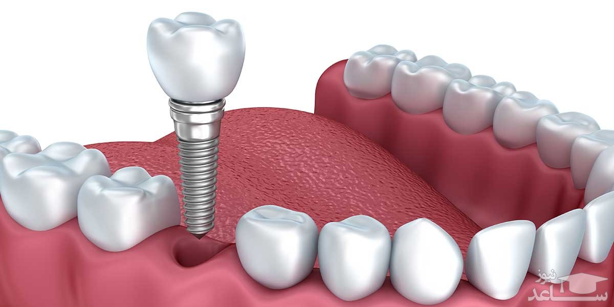 مزایای ایمپلنت دندان چیست؟