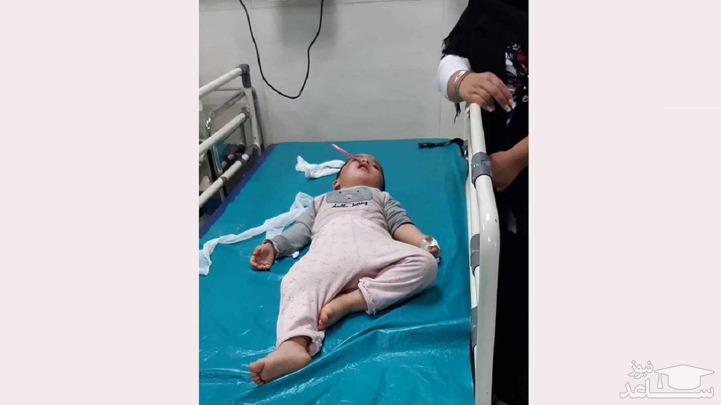 فرو رفتن قیچی خیاطی در صورت دختر بچه ۲.۵ ساله در آبیک