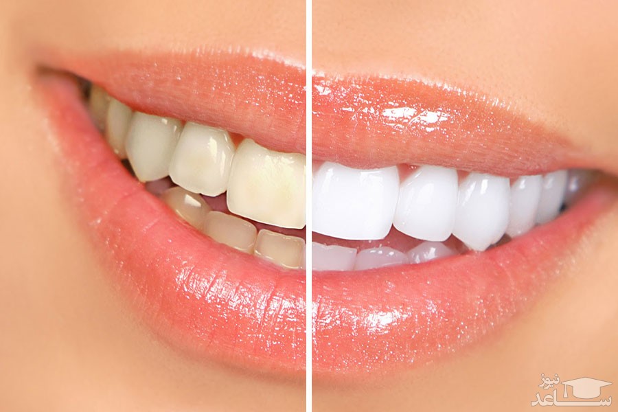 روش سفید شدن دندان های سیاه