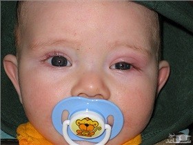 علت عفونت کردن چشم نوزاد و روش های درمان