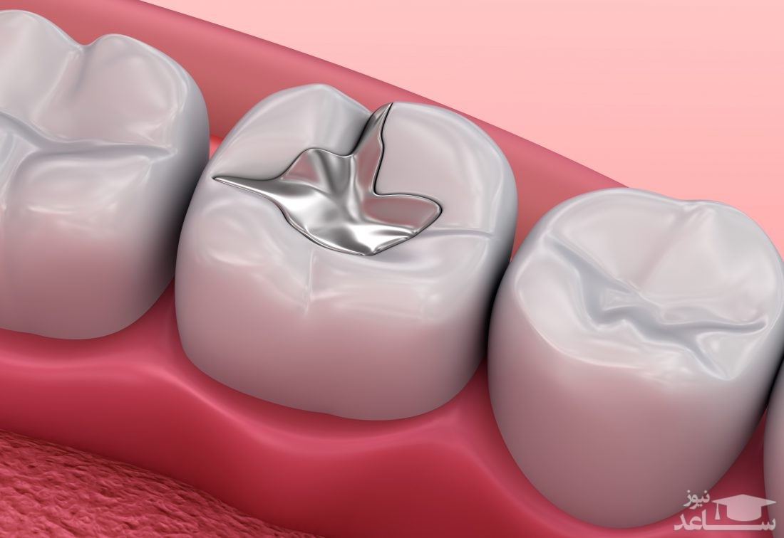 عوارض و مشکلاتی که در پر کردن دندان وجود دارند.