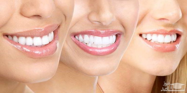 بهترین راهکار های زیبایی دندان چیست؟