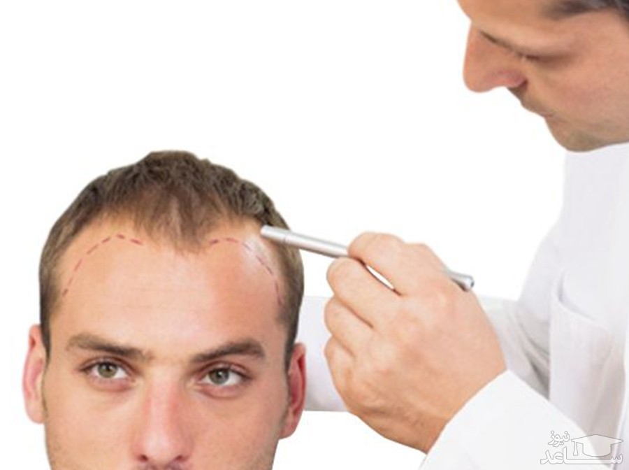 رابطه بین کاشت مو و بیماری های قلبی