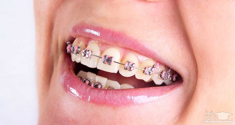 5 خطر احتمالی پلاک های فلزی اورتودنسی بر دندان