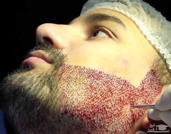 انجام کاشت ریش