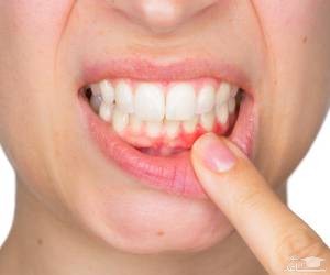 علت کیست فک و راههای درمان آن