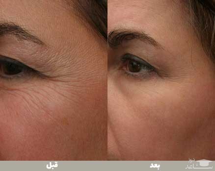 جوانسازی پوست