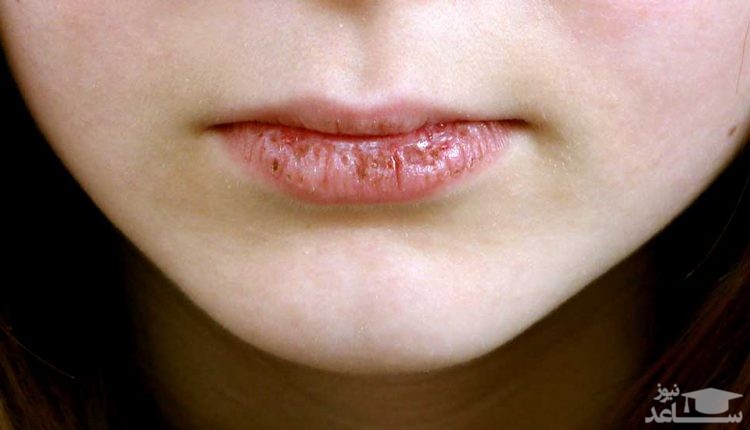 منظو از بیماری خشکی دهان چیست؟