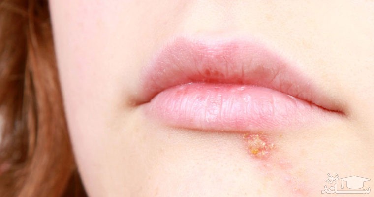 علت و درمان تبخال چیست