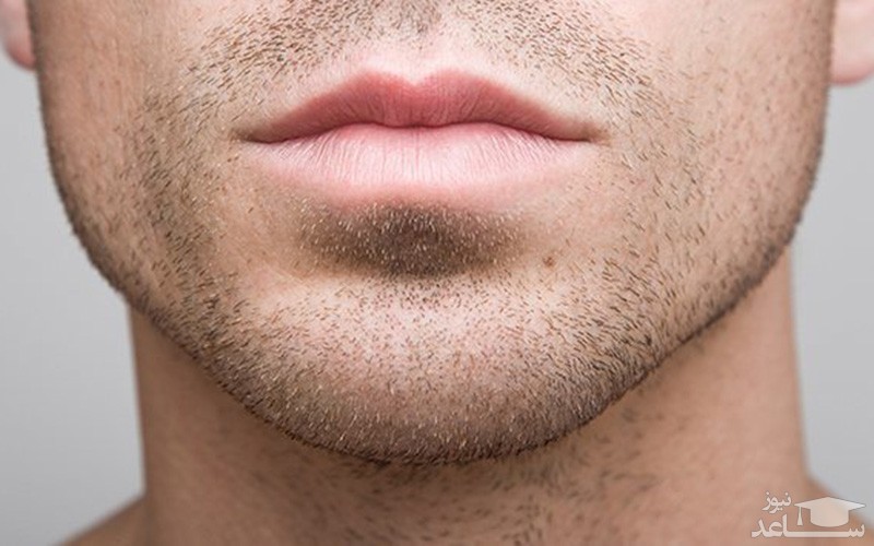 لیزر موهای زائد آقایان چگونه انجام میشود؟