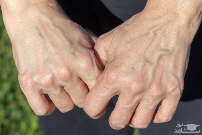 برجستگی رگ های دست نشانه چه بیماری کشنده ای است؟